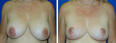 Breast Reduction Before & After Gallery - Patient 146924077 - Image 1