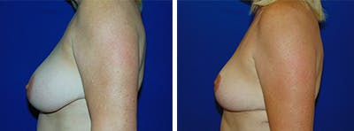 Breast Reduction Before & After Gallery - Patient 146924077 - Image 2