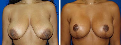 Breast Reduction Before & After Gallery - Patient 146924054 - Image 1