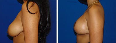 Breast Reduction Before & After Gallery - Patient 146924054 - Image 2