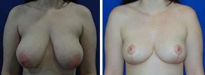 Breast Reduction Before & After Gallery - Patient 146924053 - Image 1