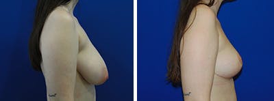 Breast Reduction Before & After Gallery - Patient 146924053 - Image 2