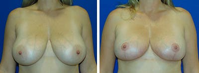 Breast Reduction Before & After Gallery - Patient 146924051 - Image 1