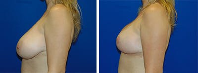 Breast Reduction Before & After Gallery - Patient 146924051 - Image 2