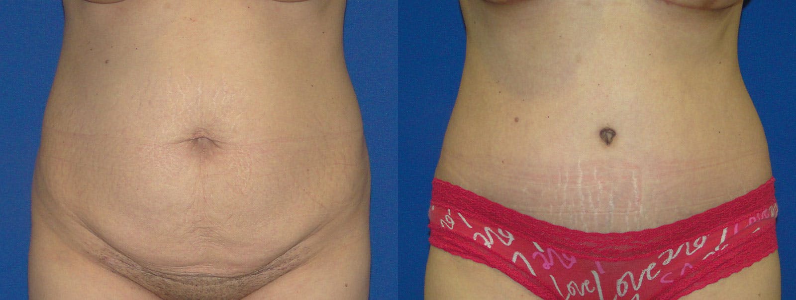 Tummy Tuck Before & After Gallery - Patient 159536368 - Image 1