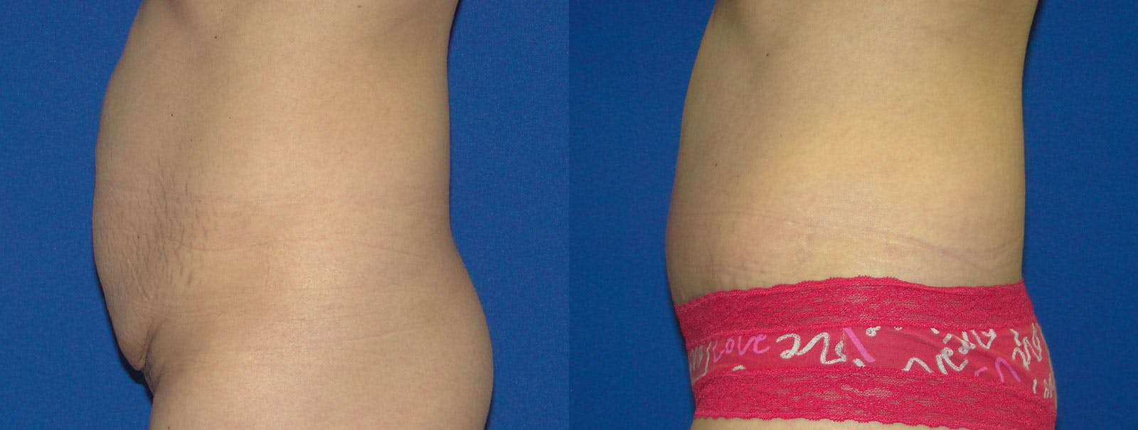 Tummy Tuck Before & After Gallery - Patient 159536368 - Image 2