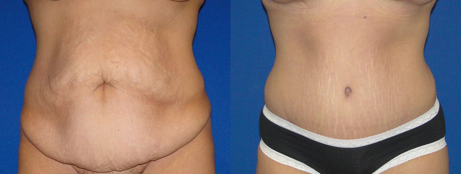 Tummy Tuck Before & After Gallery - Patient 159536369 - Image 1