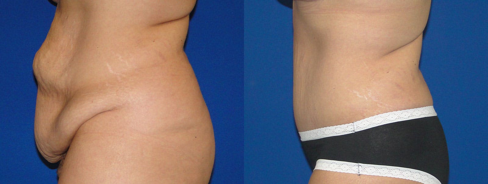 Tummy Tuck Before & After Gallery - Patient 159536369 - Image 2