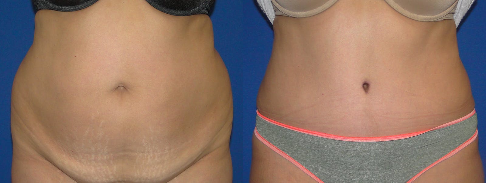 Tummy Tuck Before & After Gallery - Patient 160566143 - Image 1