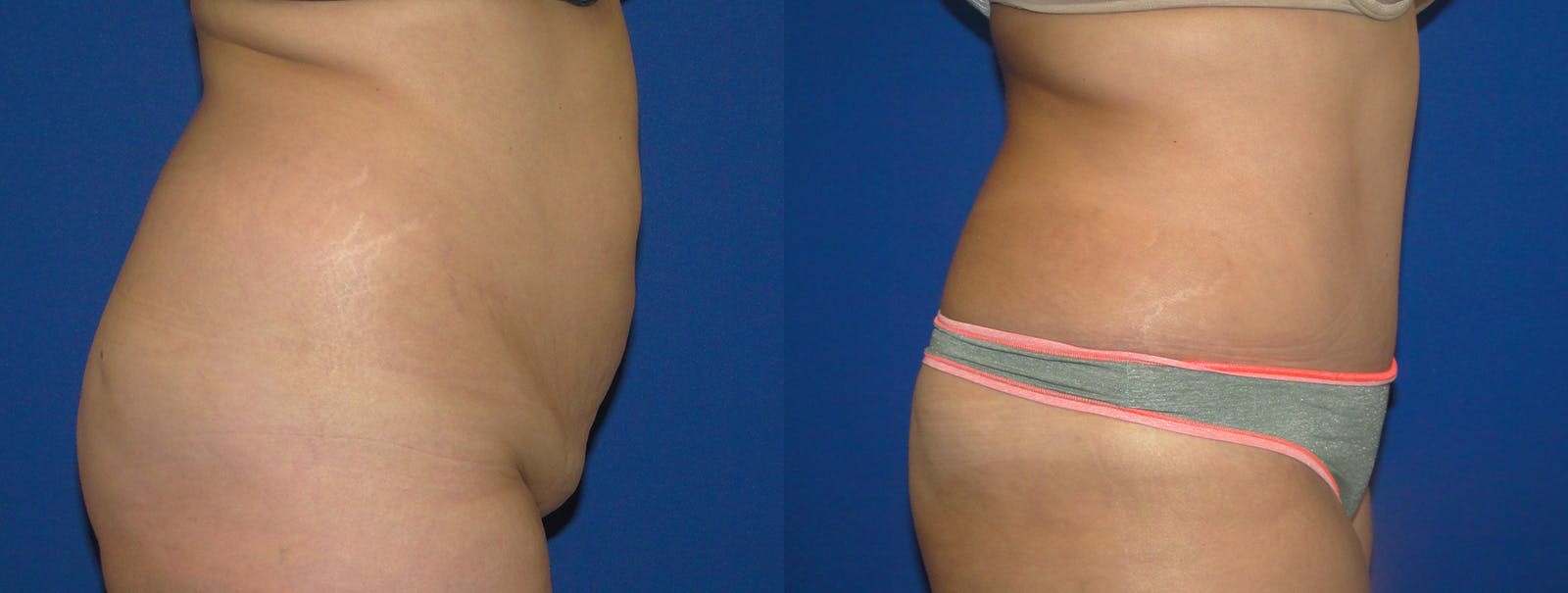 Tummy Tuck Before & After Gallery - Patient 160566143 - Image 2