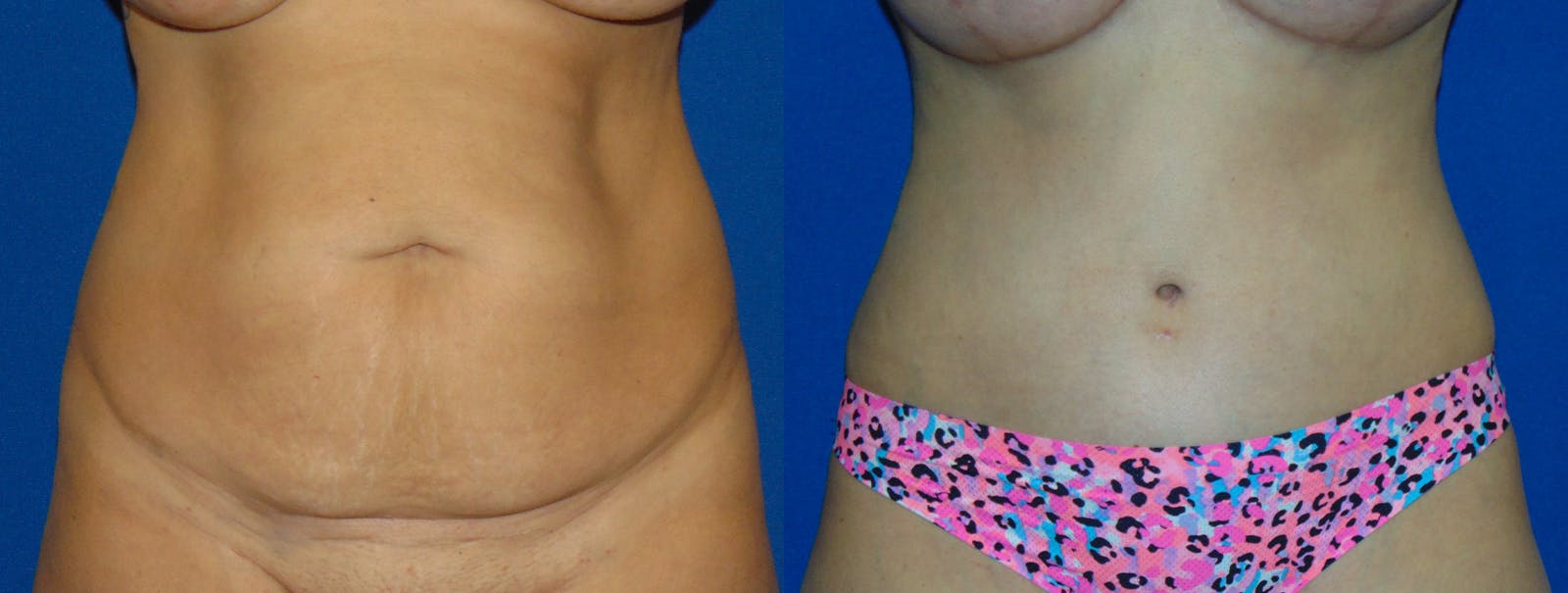 Tummy Tuck Before & After Gallery - Patient 160566144 - Image 1