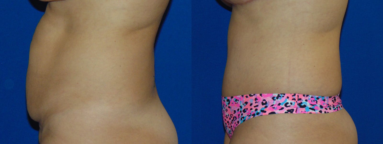 Tummy Tuck Before & After Gallery - Patient 160566144 - Image 2