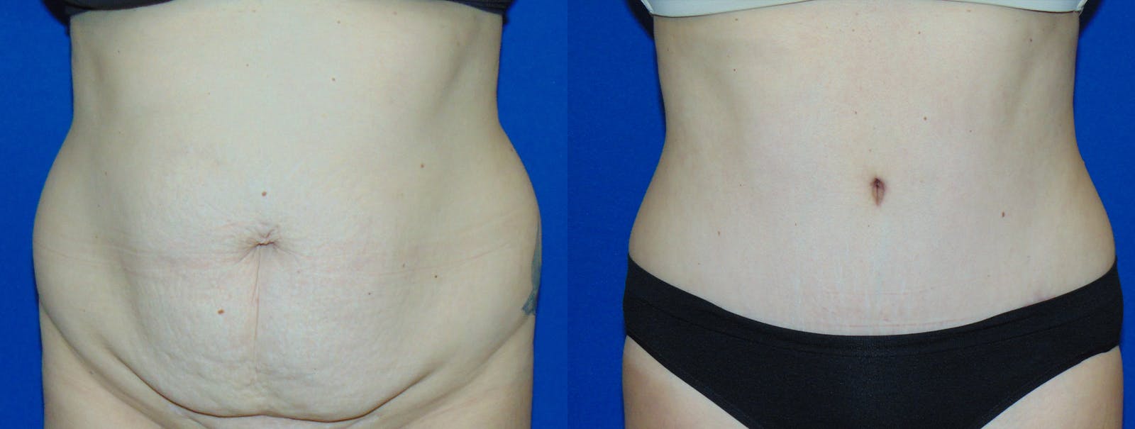 Tummy Tuck Before & After Gallery - Patient 160566145 - Image 1