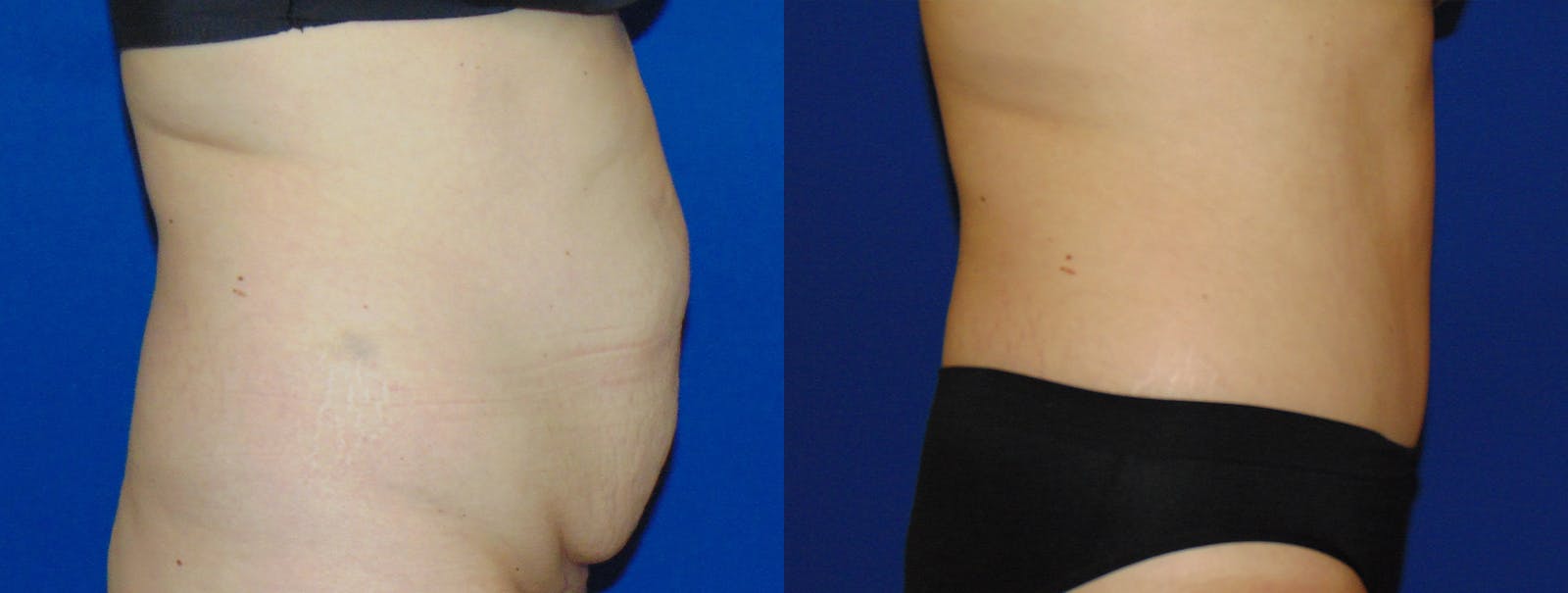 Tummy Tuck Before & After Gallery - Patient 160566145 - Image 2