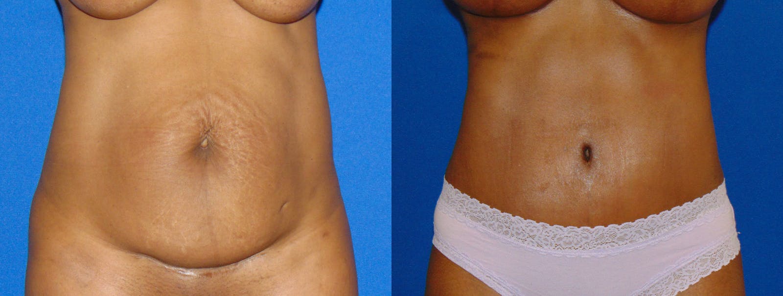 Tummy Tuck Before & After Gallery - Patient 160566146 - Image 1