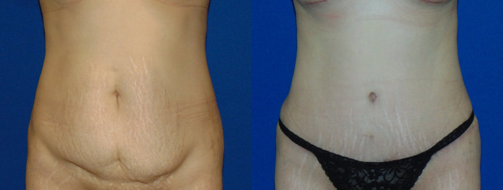 Tummy Tuck Before & After Gallery - Patient 160566147 - Image 1