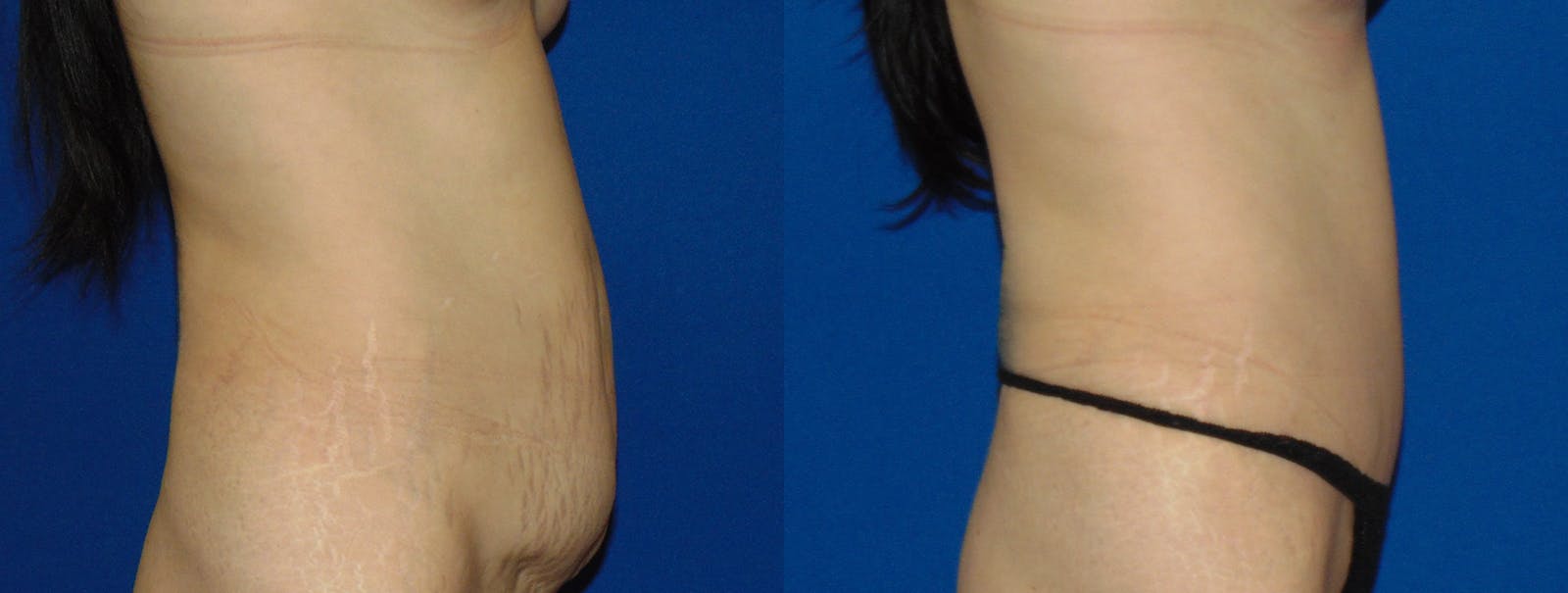 Tummy Tuck Before & After Gallery - Patient 160566147 - Image 2