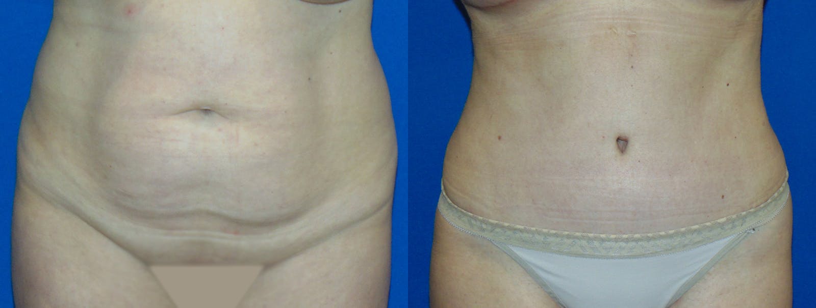 Tummy Tuck Before & After Gallery - Patient 160566148 - Image 1