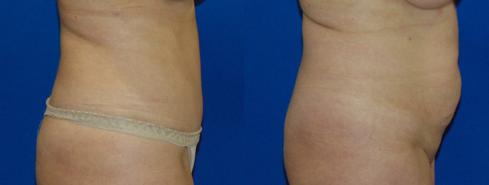 Tummy Tuck Before & After Gallery - Patient 160566148 - Image 2