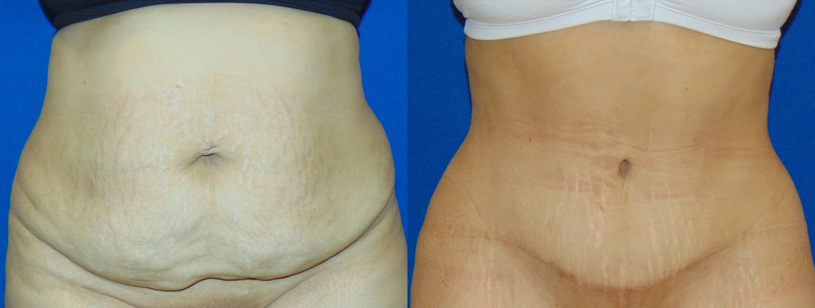 Tummy Tuck Before & After Gallery - Patient 160566149 - Image 1