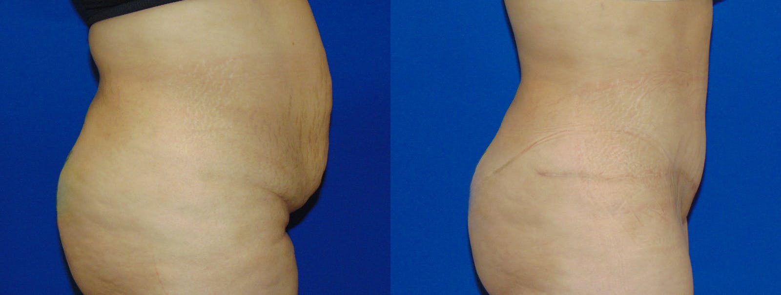 Tummy Tuck Before & After Gallery - Patient 160566149 - Image 2