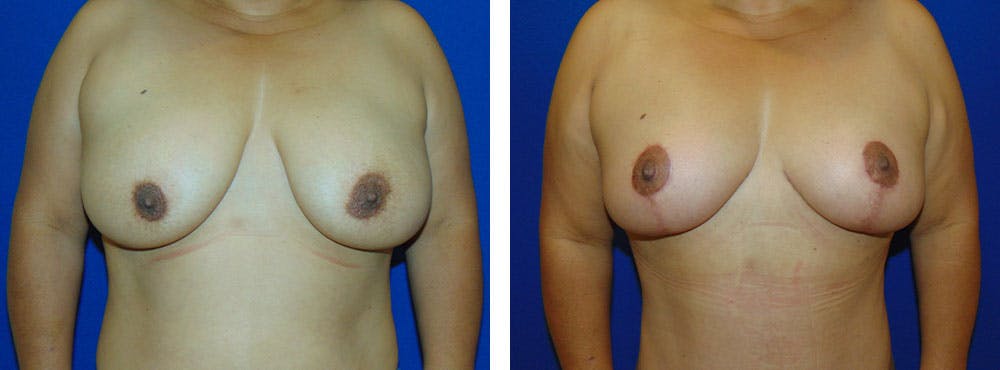 Breast Reduction Before & After Gallery - Patient 162333777 - Image 1