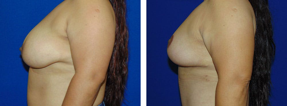 Breast Reduction Before & After Gallery - Patient 162333777 - Image 2