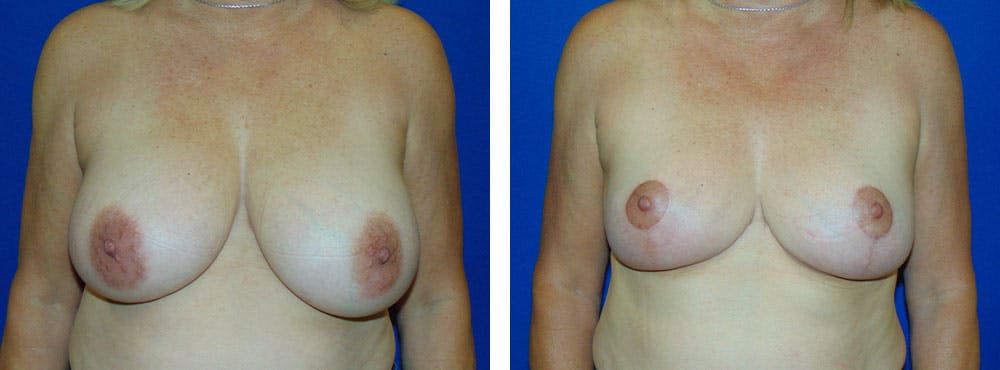 Breast Reduction Before & After Gallery - Patient 162335338 - Image 1
