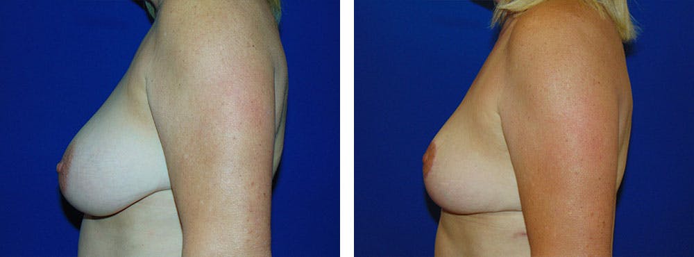 Breast Reduction Before & After Gallery - Patient 162335338 - Image 2