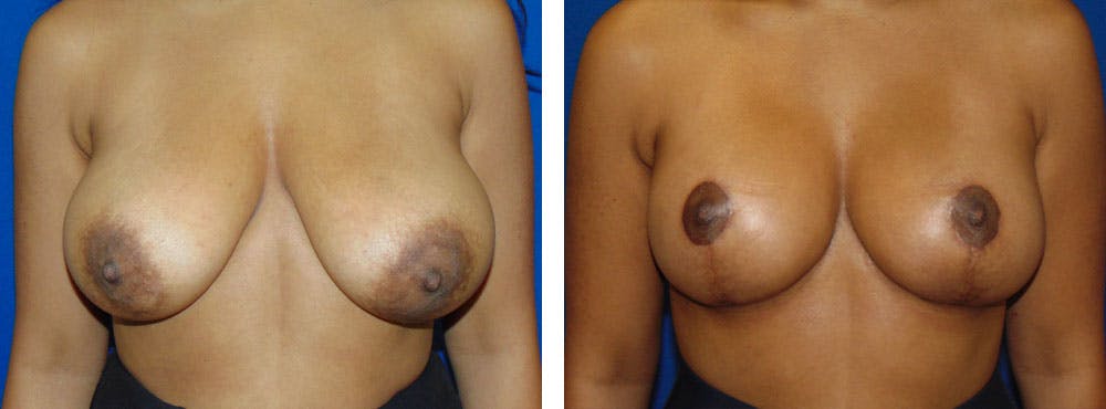 Breast Reduction Before & After Gallery - Patient 162335339 - Image 1