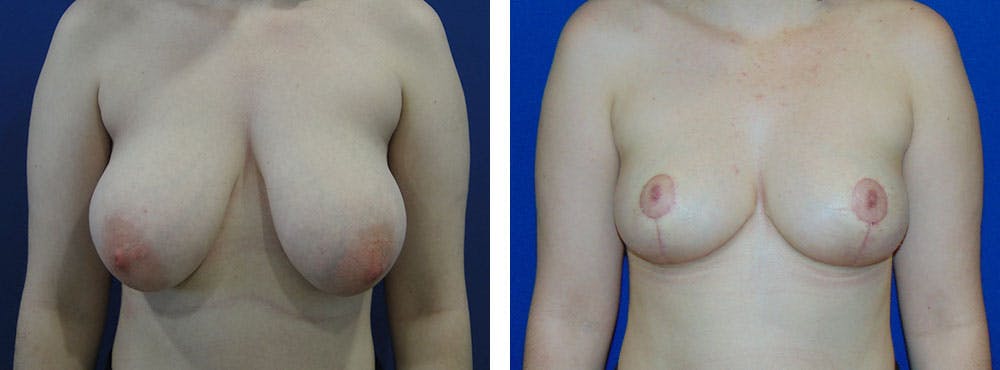 Breast Reduction Before & After Gallery - Patient 162335340 - Image 1
