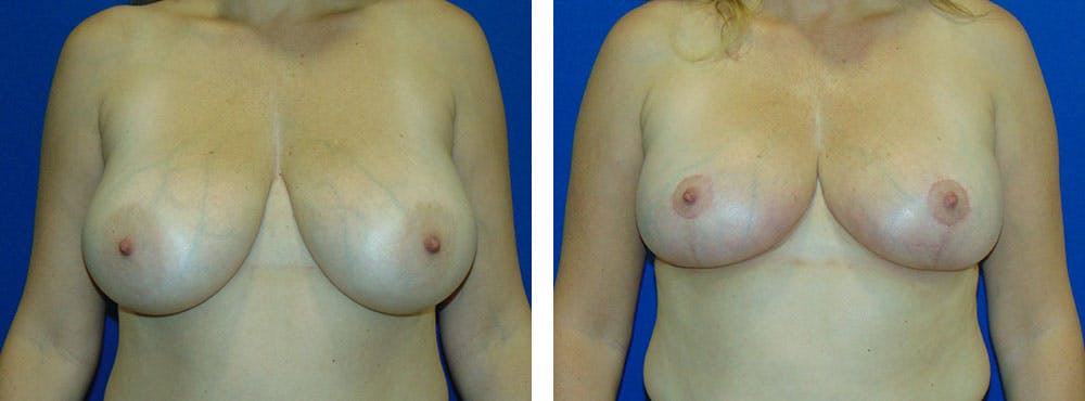Breast Reduction Before & After Gallery - Patient 162335341 - Image 1