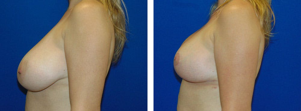 Breast Reduction Before & After Gallery - Patient 162335341 - Image 2