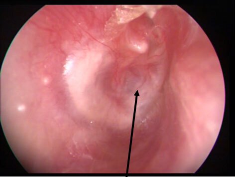 a fixed tympanic membrane perforation