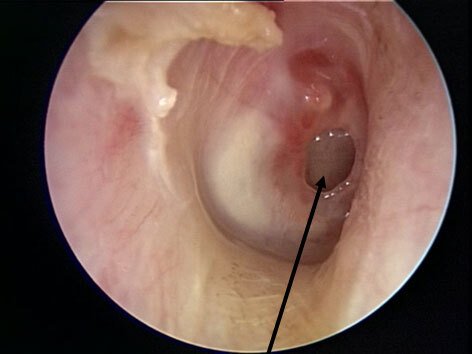 an image of a tympanic membrane perforation