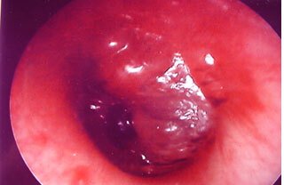 image of left acute otitis