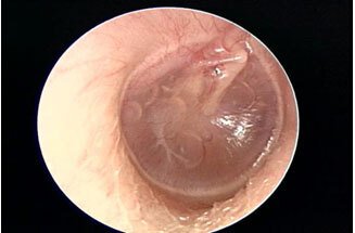 image of right otitis media with effusion