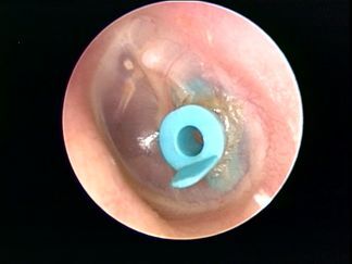 image of a Left tympanic membrane with pressure equalization tube