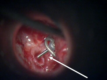 image of a missing middle ear bone replaced with implant