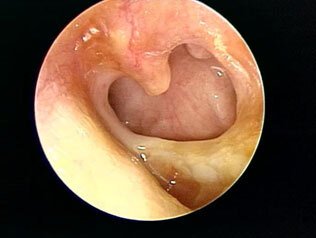 an image of the left chronic ear drum perforation.
