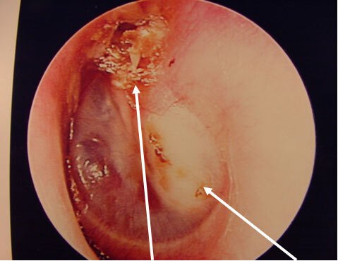 an image of the Cholesteatoma source and extension to middle ear behind the ear drum