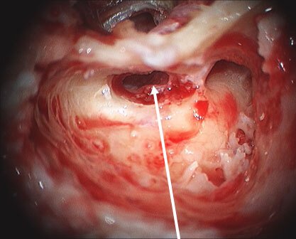 image of a left mastoidectomy with exposure of the cholesteatoma.