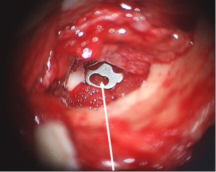 image of left ear with titanium implant to replace hearing bones