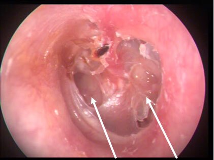 image of a left eardrum with perforation and cholesteatoma