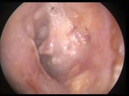 image of the left eardrum after repair
