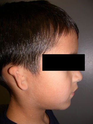 an image of a child with some ear malformation
