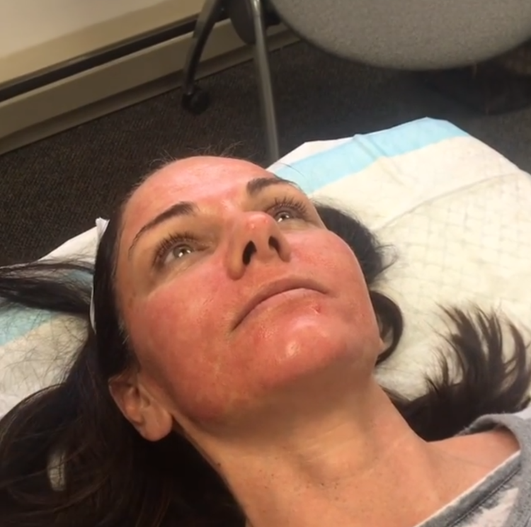 Microneedling Lexington MA Face Forward Medical Aesthetics