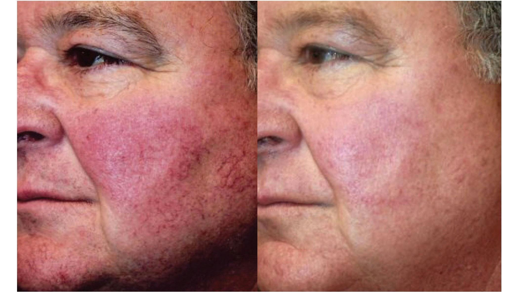 Forever Young BBL Before & After Gallery - Patient 58172302 - Image 1