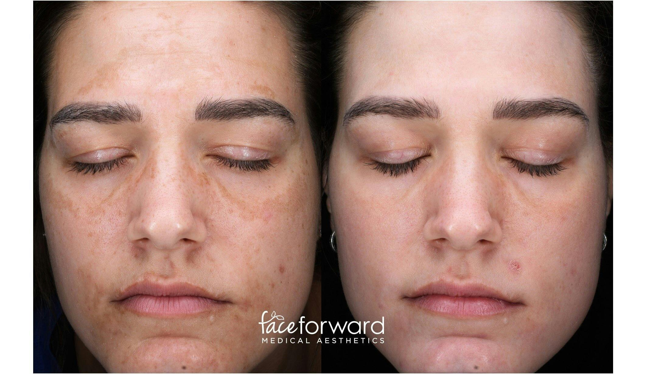 Halo Laser Resurfacing Before & After Gallery - Patient 58178646 - Image 1