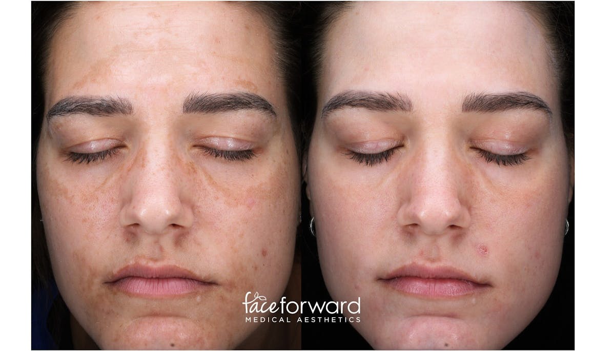 Halo Laser Resurfacing Before & After Gallery - Patient 58178646 - Image 1